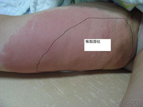淋巴管炎怎样治疗？-dnf织炎